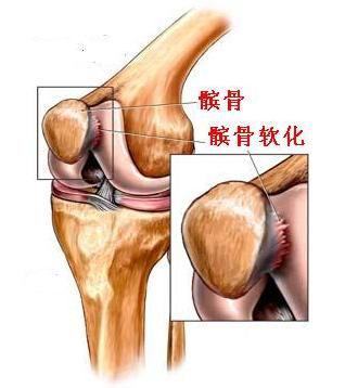 练体育膝盖疼怎么治_练体育膝盖疼怎么治疗