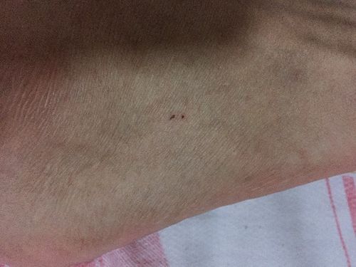 新澳门彩开奖结果今天和被蛇咬两年仍后遗症与被蛇咬了几年后身体有毒素吗